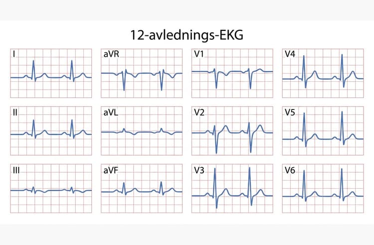 Kliniskt tolvanaligt EKG med extremitets- och bröstavledningar.
