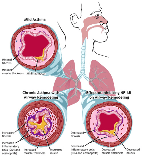 Schematisk bild av normal luftväg och astmatisk luftväg med bronkförträngning, inflammation, slem och remodellering