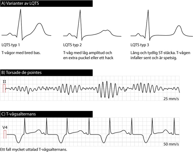 Figur 8. De tre vanligaste typerna av LQTS och deras karaktäristiska EKG-bild. Lång QT tid leder till ventrikeltakykardi av typen torsade de pointes.