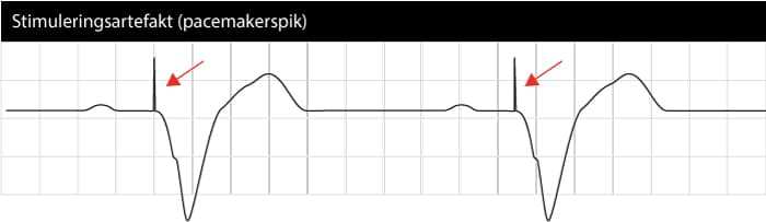Pacemaker EKG