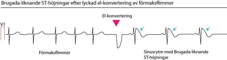 ST-höjning efter el-konvertering